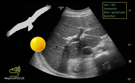 The Pocus Kingdom Nephropocus