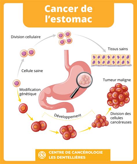 Cancer de lestomac les symptômes aux premiers stades