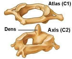 Atlas axis | Joints anatomy, Subluxation, Anatomy bones