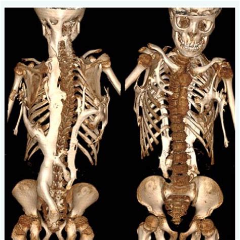 Thoracic Ct Scan With Reconstruction Significant Extra Skeletal And Download Scientific