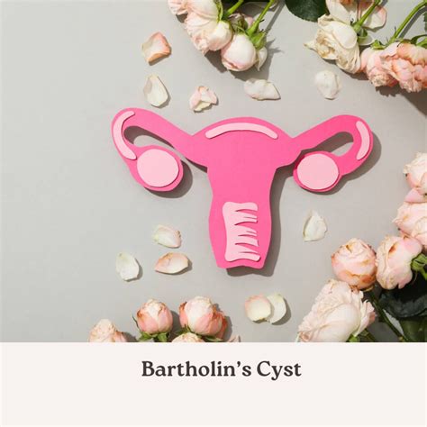 Bartholins Cyst Morkare Natural Clinic