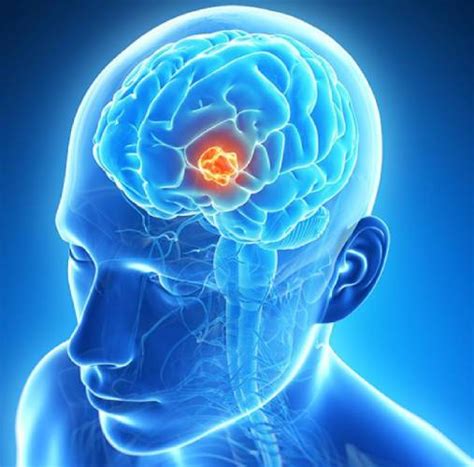 Brain Tumors Types Symptoms And Causes Its Psychology