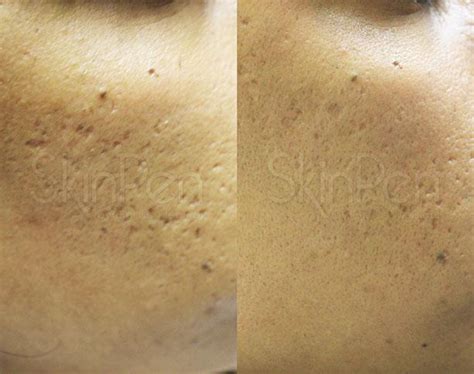 Microneedling Gallery Downtown Dc Washington Dc Metroderm Dc