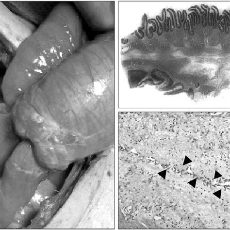 Intraoperative Appearance Of The Jejunal Intussusception Segment