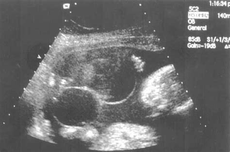 Ambiguous Genitalia Ultrasound