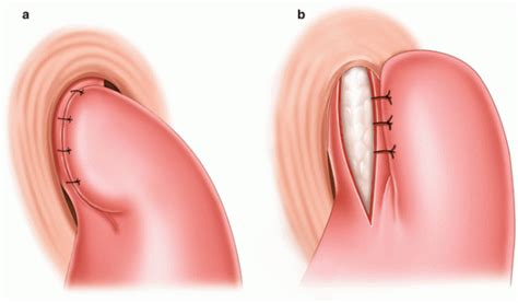 Laparoscopic Heller Myotomy and Fundoplication. What Type? | Thoracic Key