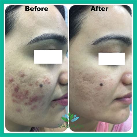 Acne Treatment in Delhi, Pimples Treatment Cost in Delhi - Dr. Jyoti Sharma