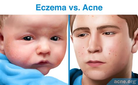 Eczema (Atopic Dermatitis) - Acne.org