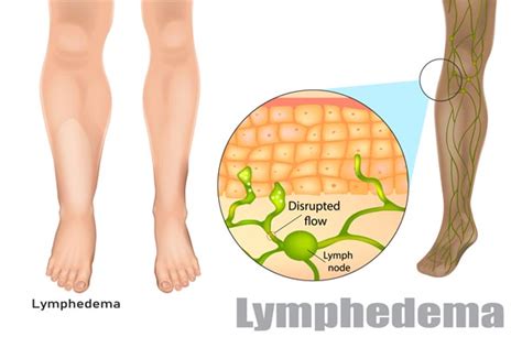 What Causes Lymphedema Live Today Foundation