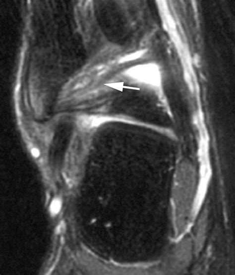 Mr Imaging Of Ankle Impingement Syndromes Ajr