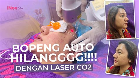 Manfaat Perawatan Laser Co Fractional Inovglow Klinik Spesialis