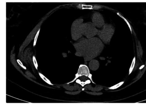 Fibroelastoma Dorsi Derecho Se Observa Una Lesión Con Bandas