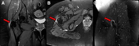 Three Grade Magnetic Resonance ImagingBased Gluteus Medius And Or