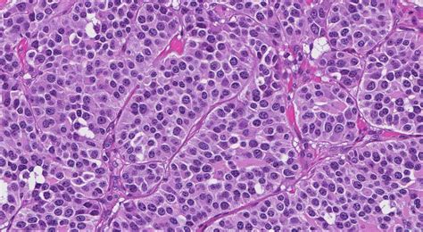 Medullary Thyroid Carcinoma Atlas Of Pathology