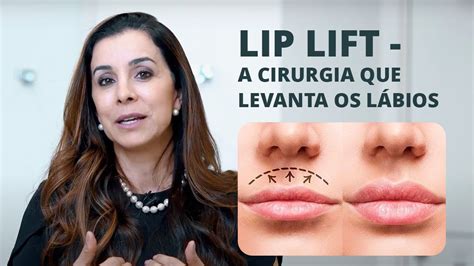 LIP LIFT A CIRURGIA QUE LEVANTA OS LÁBIOS YouTube