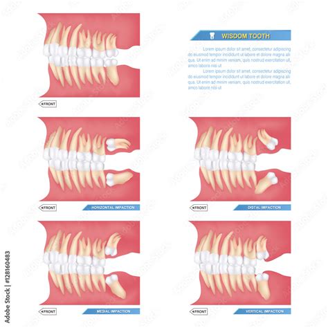 Vetor De Set Of Impacted Wisdom Tooth Dental Problems Horizontal