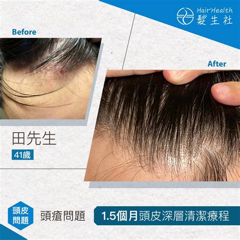 漢方中藥頭皮spa護理 解決嚴重頭皮問題 頭皮濕疹 頭皮炎 Hairhealth