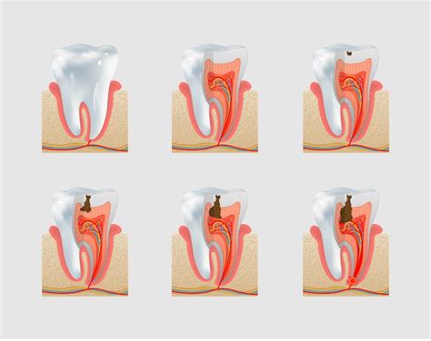 How Do Cavities Form in Your Teeth (Tooth Decay Reduction Knowledge)