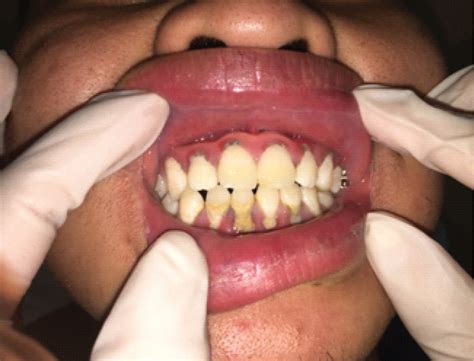 Necrotizing Ulcerative Gingivitis Before And After