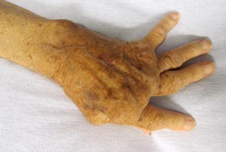 Rheumatoid Arthritis IMAGE EurekAlert Science News Releases