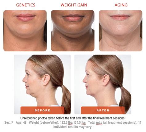 Kybella Double Chin Treatment Atlanta Ga Dr Burke Robinson