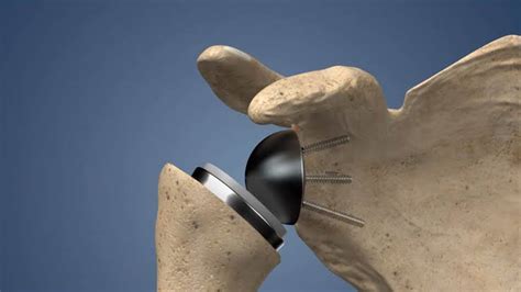 Shoulder Replacement Surgery Malioon