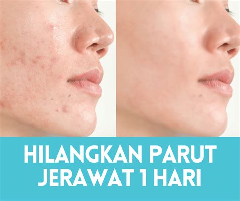 Cara Nak Hilangkan Parut Jerawat Dalam Masa Hari