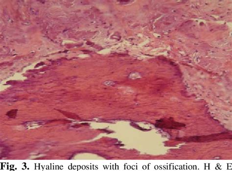 Figure 3 From A Case Report Of Primary Localized Amyloidosis Of Eyelid With Extensive