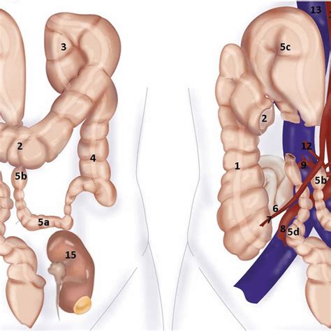 Schematic Drawing Of The Anatomical Abnormalities 1 Ascending Colon Download Scientific