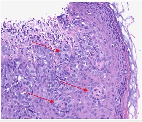 Punch Biopsy Of The Scrotal Lesion Showing Classic Pagetoid Cells With Download Scientific