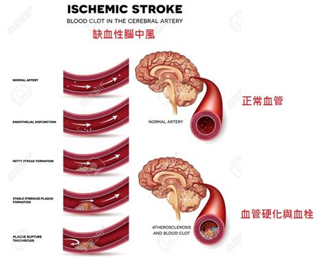 急性缺血性中風復健關鍵期 張其軒醫師：eecp體外反搏效果顯著 台灣好新聞 Taiwanhot