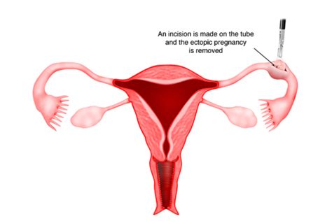 lap ectopic pregnancy | Ectopic pregnancy treatment in Pune - Dr. Kunaal Shinde