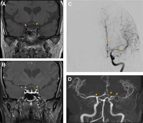 Central Nervous System Vasculitis Rheumatic Disease Clinics