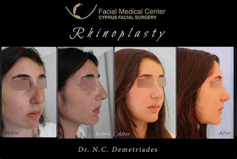 Before And After Cyprus Facial Surgery