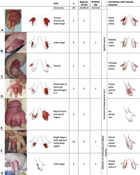 Anatomical Patterns Of Infantile Hemangioma Ih Of The Extremities