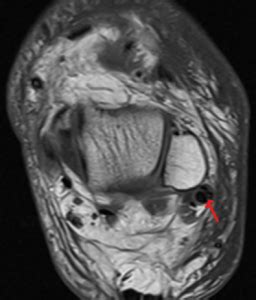 MRI Findings of Peroneal Tendon Pathology - Sports Medicine Review