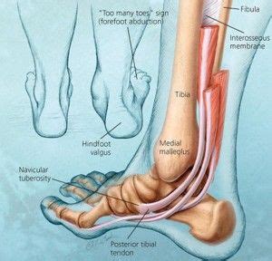 Pin On Ankle Fractures