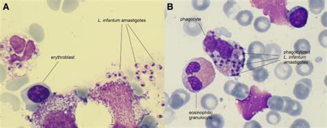 Visceral Leishmaniasis Bone Marrow