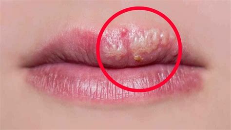 Herpes Labial Y Oral Diagn Stico Tratamiento Y Prevenci N Fuegos