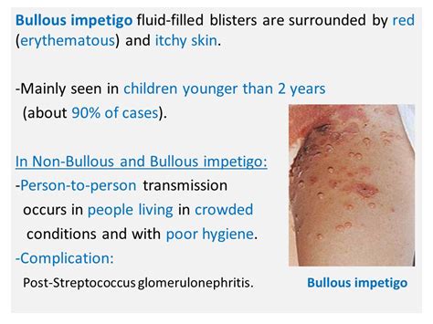 Skin And Soft Tissue Infections Impetigo Impetigo Is Superficial