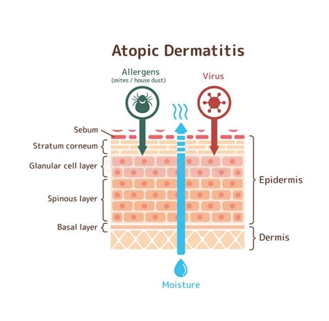 Atopic Dermatitis Atopic Eczema Factors That Cause Disease C Stock