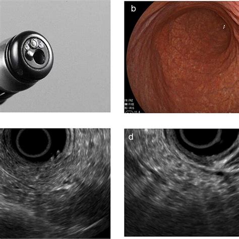 Direct Forward Viewing Radial Endoscopic Ultrasound Fr Eus A The Download Scientific