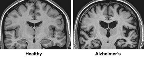 MRI Images for healthy and Alzheimer | Download Scientific Diagram