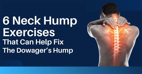 Neck Hump Exercises That Can Help Fix The Dowagers Hump