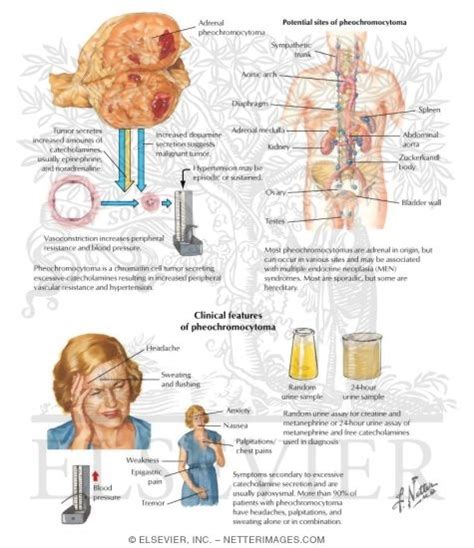 Pheochromocytoma