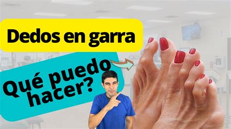 Qu Ejercicios Puedo Hacer Si Tengo Dedos En Garra Youtube