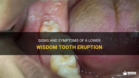 Signs And Symptoms Of A Lower Wisdom Tooth Eruption Medshun