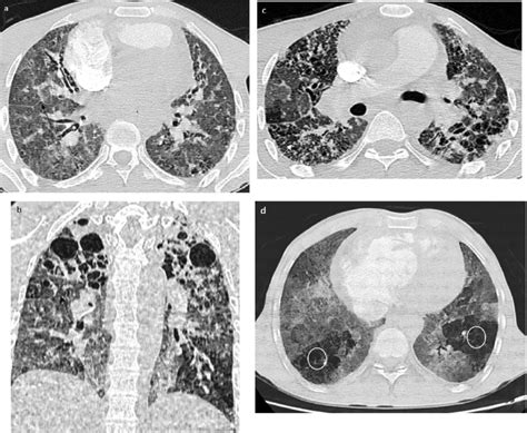 A Year Old Man With Copd Follow Up Contrast Enhanced Axial A C And