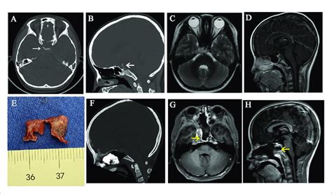 | A case illustrates dorsum sellae and posterior clinoid process ...