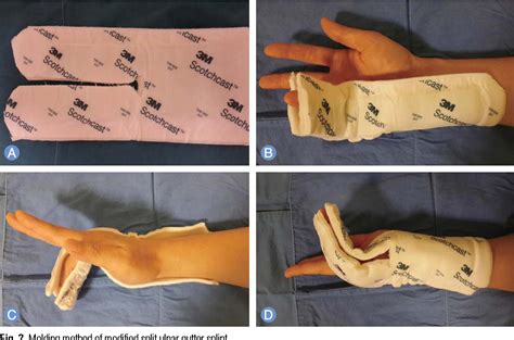 What Is An Ulnar Gutter Splint At Latoya Johnson Blog